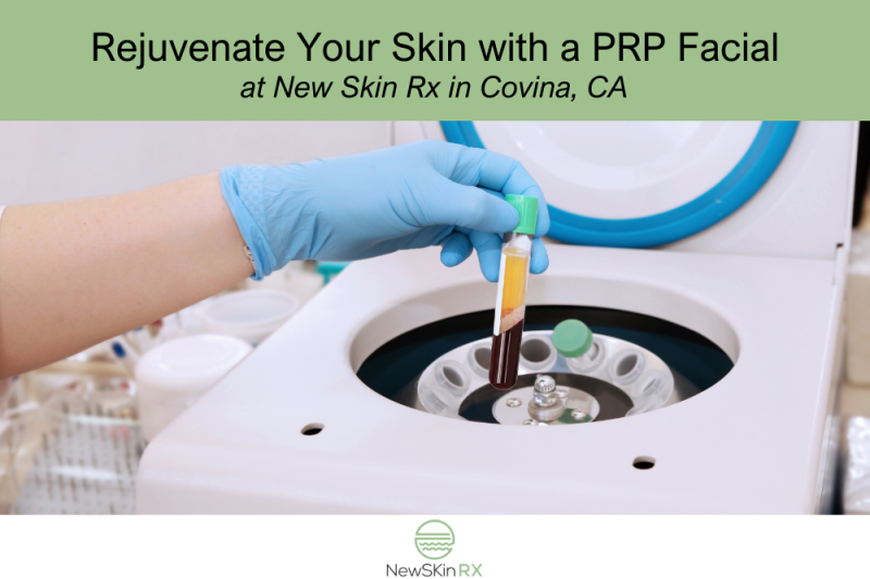 Rejuvenate Your Skin with a PRP Facial at New Skin Rx